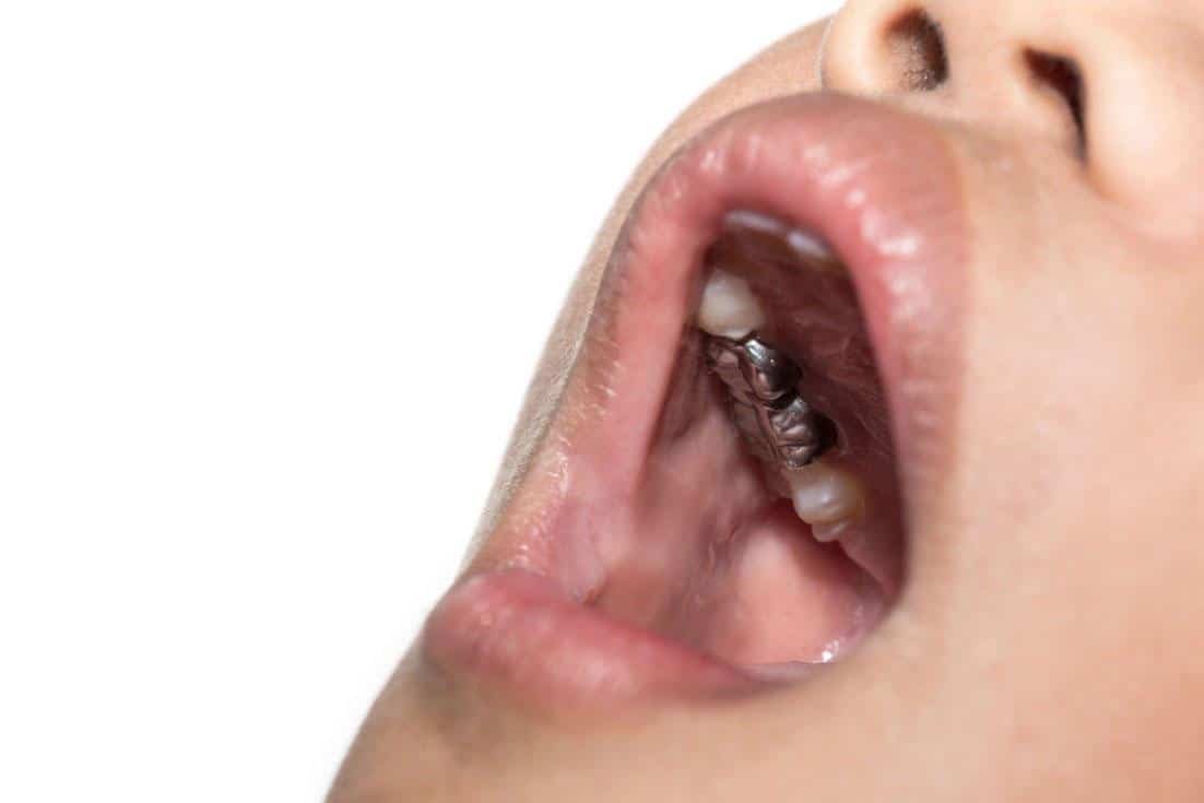 Pediatric Crowns